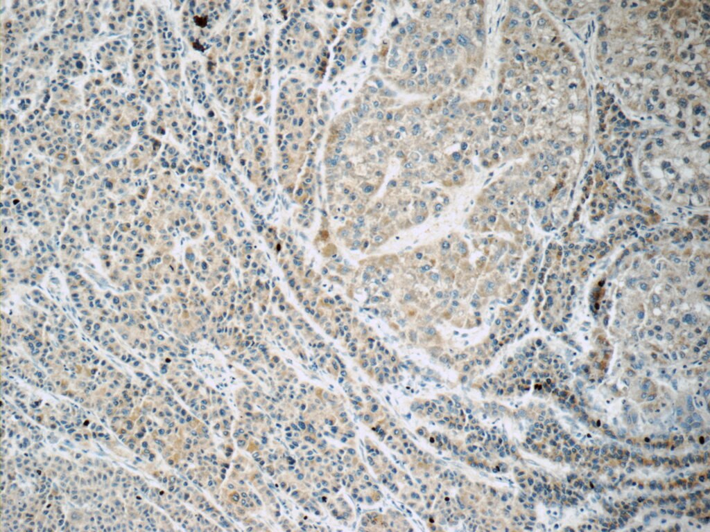 Immunohistochemistry (IHC) staining of human liver cancer tissue using FREM1 Polyclonal antibody (13086-1-AP)