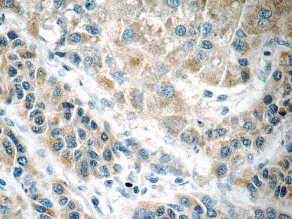 Immunohistochemistry (IHC) staining of human liver cancer tissue using FREM1 Polyclonal antibody (13086-1-AP)