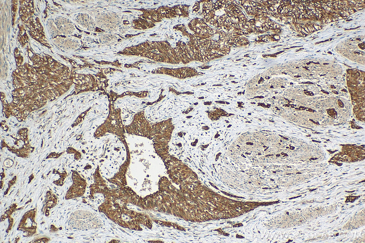 Immunohistochemistry (IHC) staining of human urothelial carcinoma tissue using FRK Polyclonal antibody (16197-1-AP)