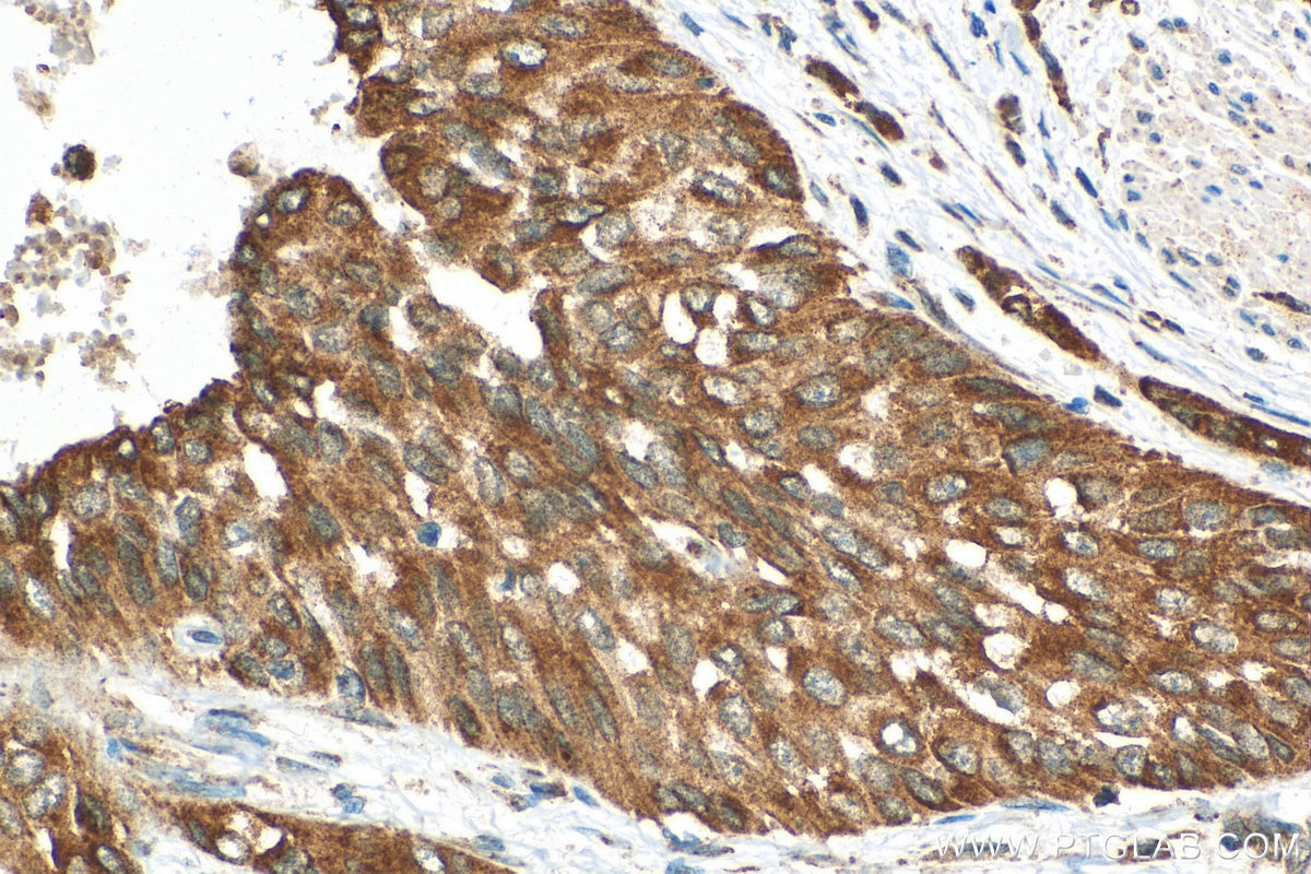 Immunohistochemistry (IHC) staining of human urothelial carcinoma tissue using FRK Polyclonal antibody (16197-1-AP)