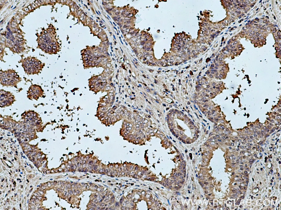 Immunohistochemistry (IHC) staining of human prostate cancer tissue using FRS2 Polyclonal antibody (11503-1-AP)