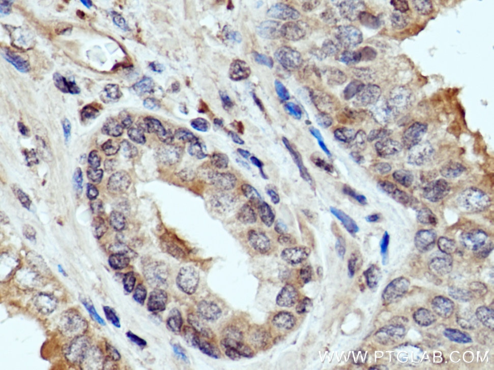 Immunohistochemistry (IHC) staining of human prostate cancer tissue using FRS2 Polyclonal antibody (11503-1-AP)