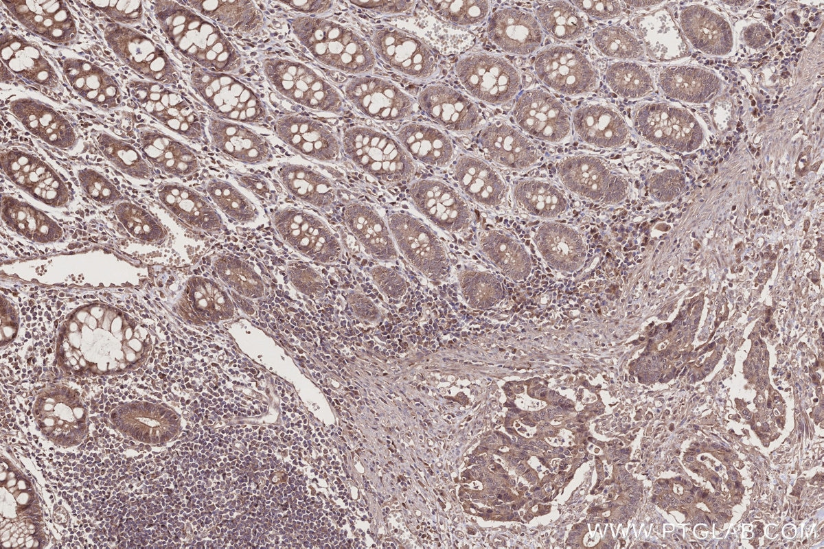 Immunohistochemistry (IHC) staining of human rectal cancer tissue using FRS2 Polyclonal antibody (11503-1-AP)