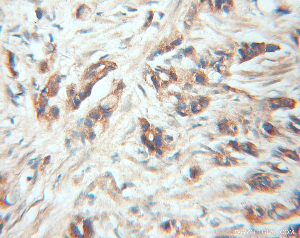 Immunohistochemistry (IHC) staining of human prostate cancer tissue using FRS2 Polyclonal antibody (11503-1-AP)