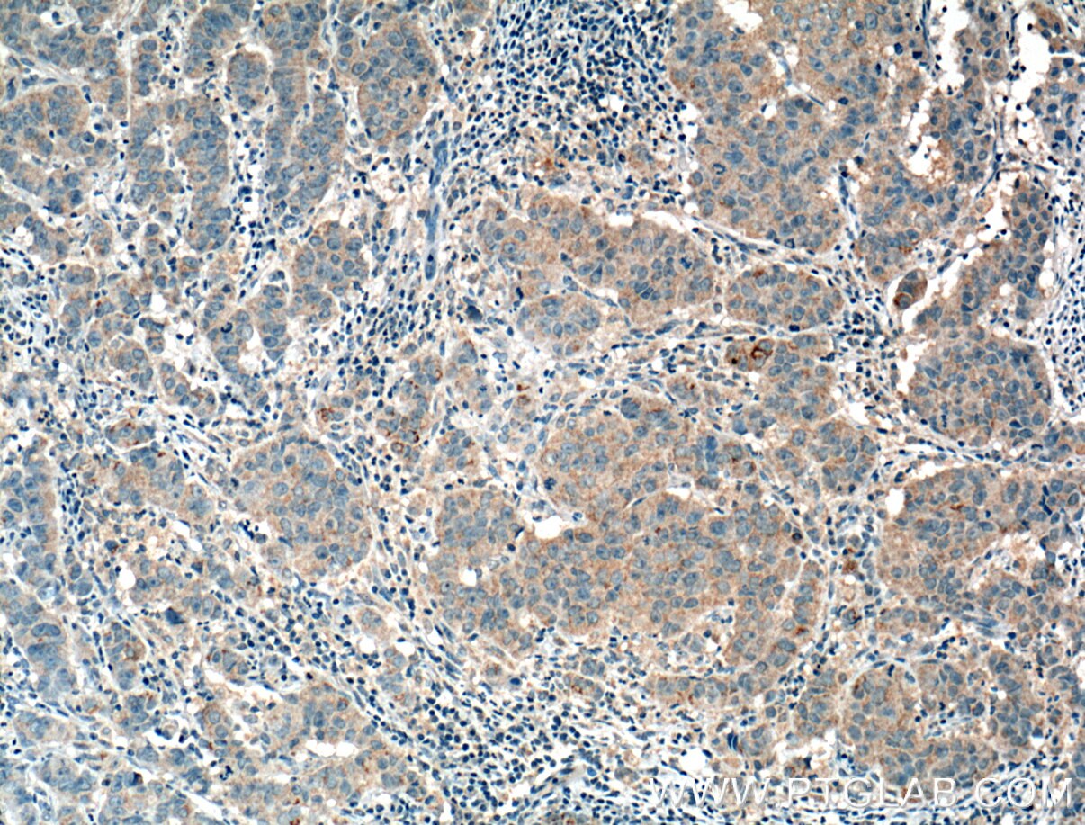 Immunohistochemistry (IHC) staining of human prostate cancer tissue using FRS2 Monoclonal antibody (66263-1-Ig)