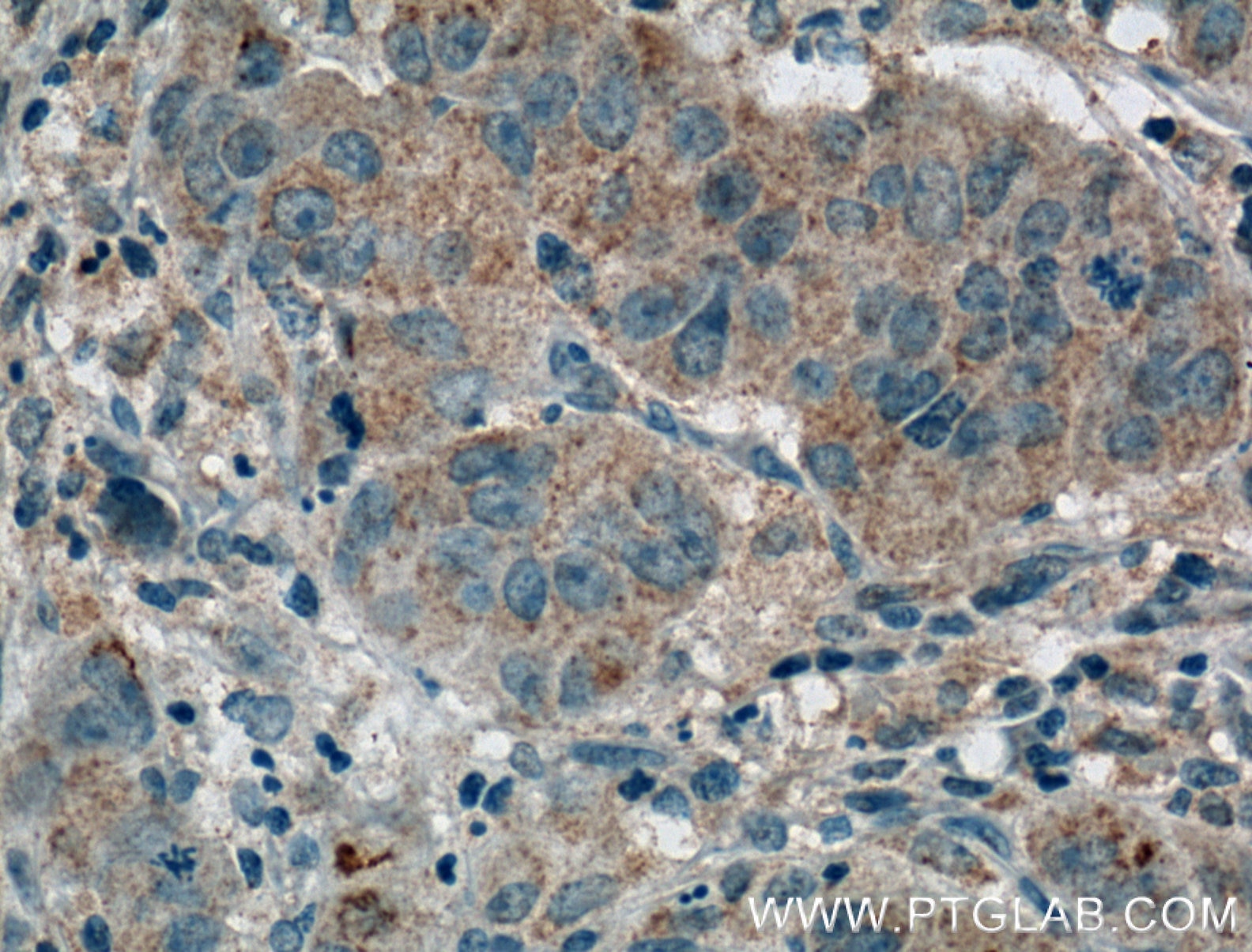 Immunohistochemistry (IHC) staining of human prostate cancer tissue using FRS2 Monoclonal antibody (66263-1-Ig)