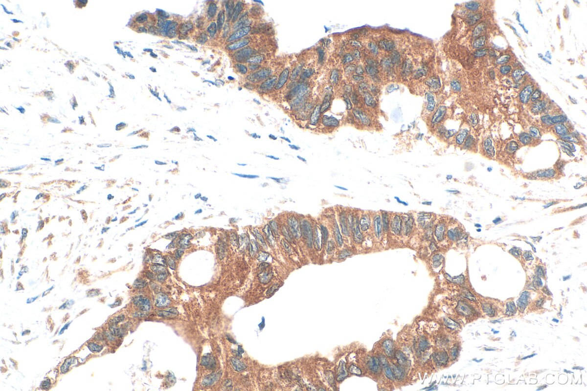 Immunohistochemistry (IHC) staining of human urothelial carcinoma tissue using FRY Polyclonal antibody (32075-1-AP)