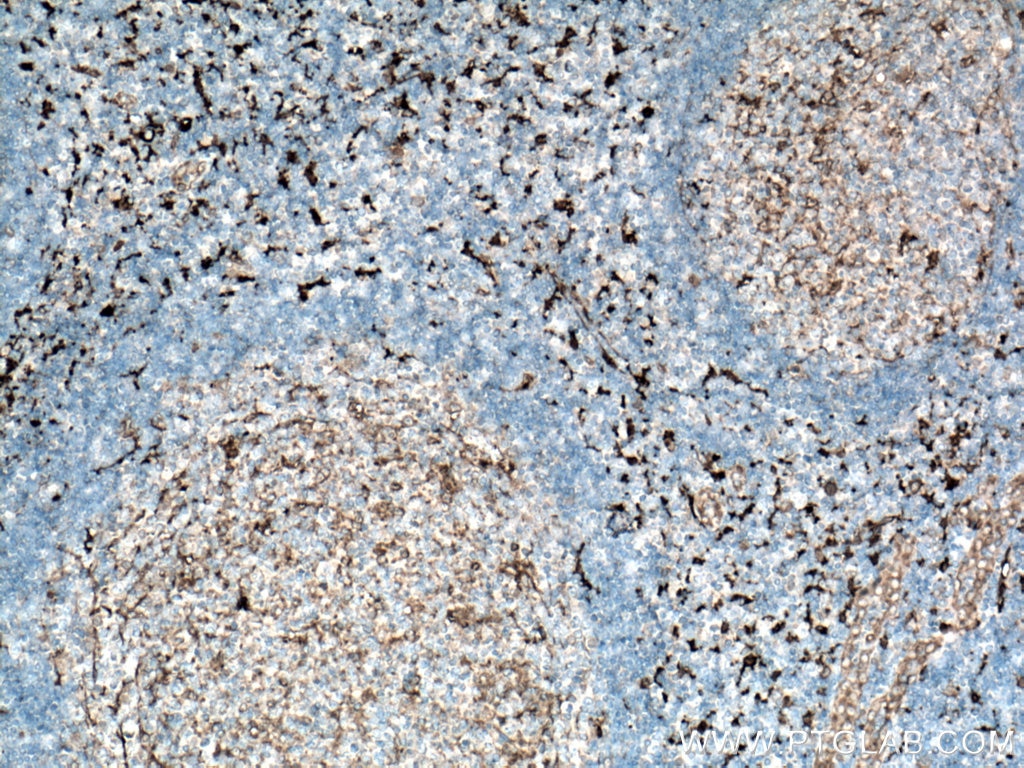 Immunohistochemistry (IHC) staining of human tonsillitis tissue using Fascin Polyclonal antibody (14384-1-AP)