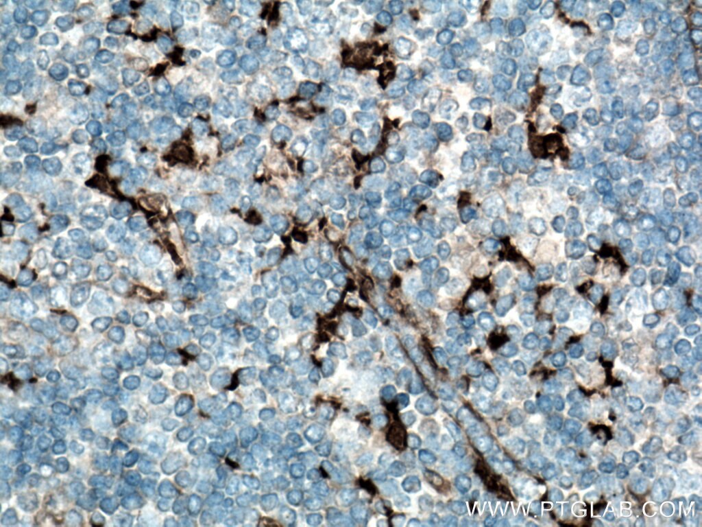 Immunohistochemistry (IHC) staining of human tonsillitis tissue using Fascin Polyclonal antibody (14384-1-AP)