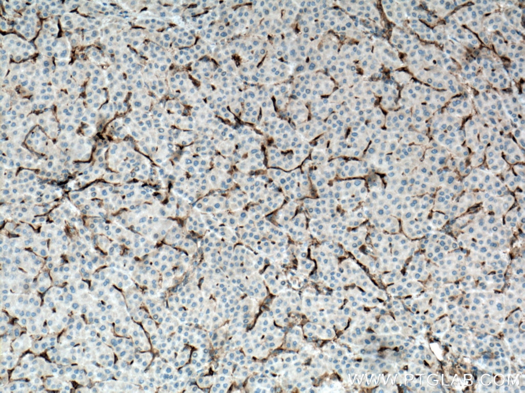 IHC staining of human liver cancer using 14384-1-AP