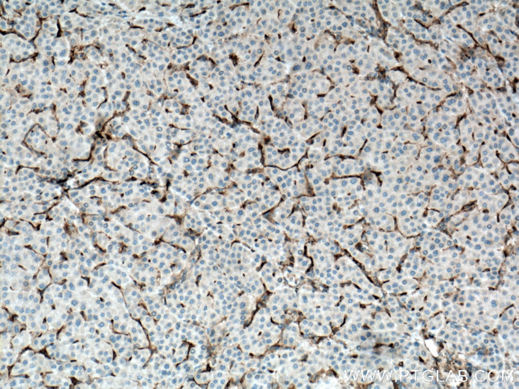 Immunohistochemistry (IHC) staining of human liver cancer tissue using Fascin Polyclonal antibody (14384-1-AP)