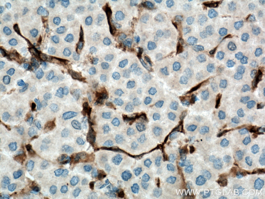 Immunohistochemistry (IHC) staining of human liver cancer tissue using Fascin Polyclonal antibody (14384-1-AP)