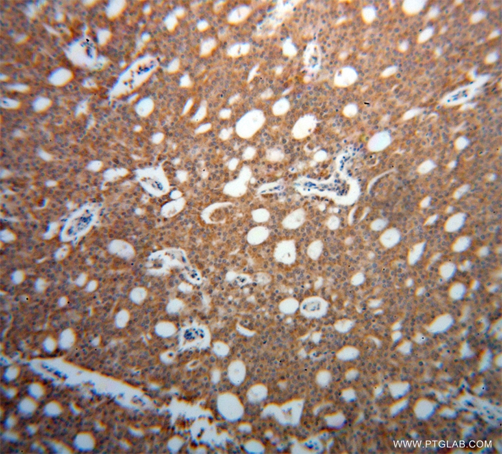 Immunohistochemistry (IHC) staining of human prostate cancer tissue using FSCN3 Polyclonal antibody (13536-1-AP)
