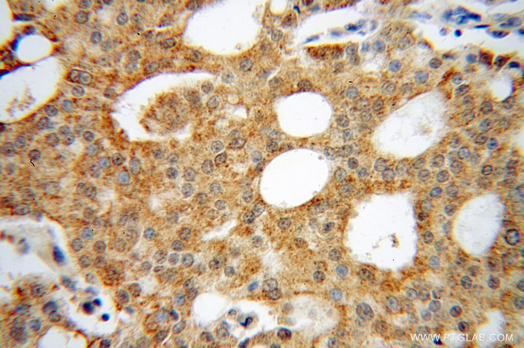 Immunohistochemistry (IHC) staining of human prostate cancer tissue using FSCN3 Polyclonal antibody (13536-1-AP)