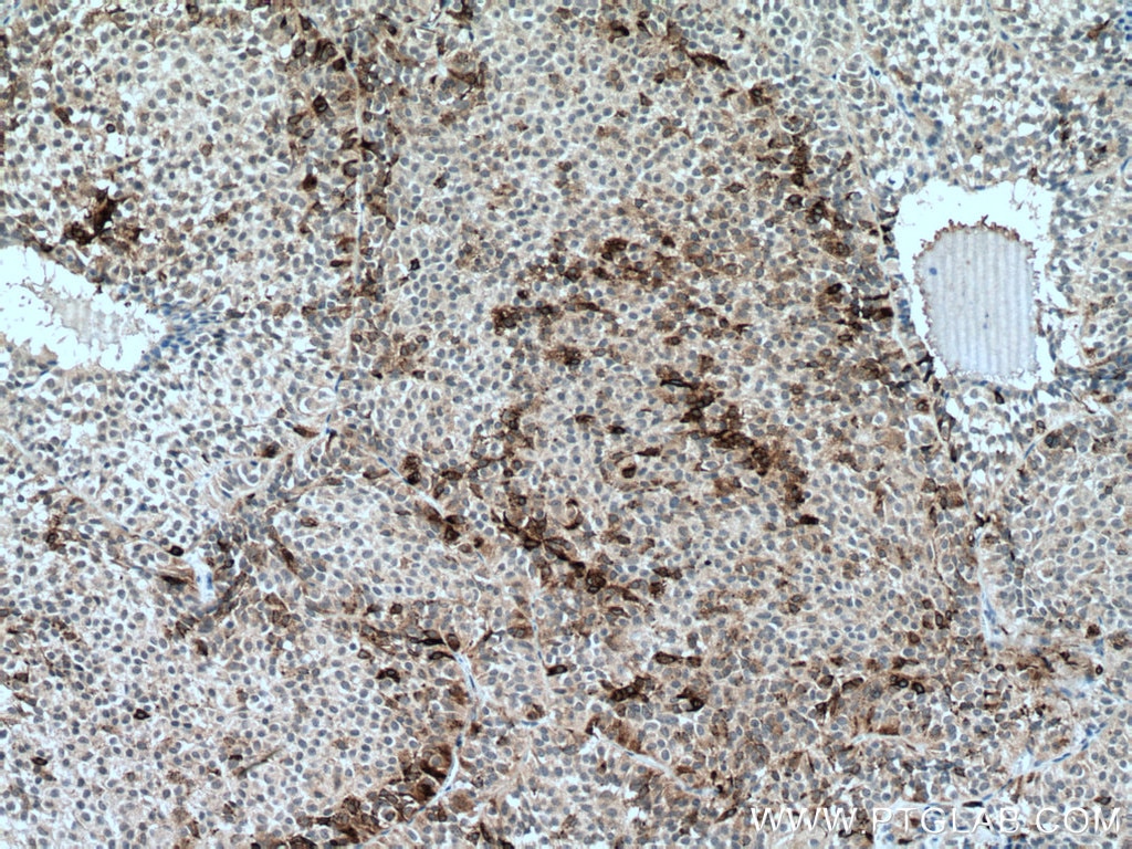 Immunohistochemistry (IHC) staining of human pituitary adenoma tissue using FSHB Monoclonal antibody (67131-1-Ig)