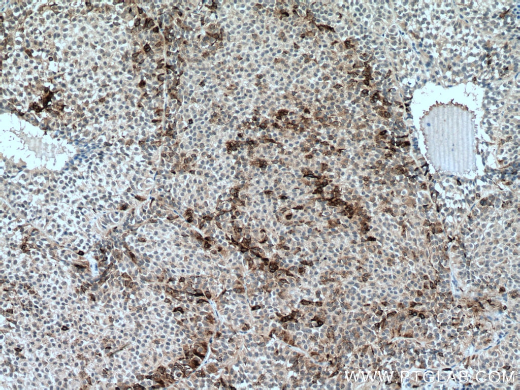 Immunohistochemistry (IHC) staining of human pituitary adenoma tissue using FSH beta Monoclonal antibody (67131-1-Ig)