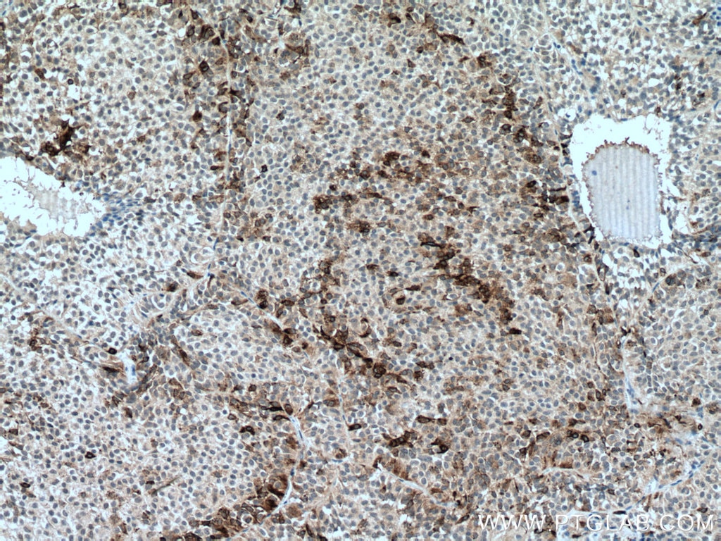 IHC staining of human pituitary adenoma using 67131-1-Ig