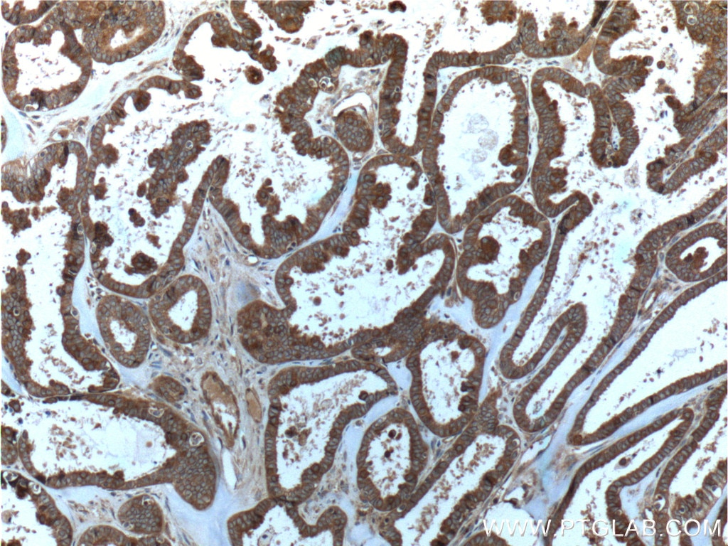 Immunohistochemistry (IHC) staining of human ovary tumor tissue using Follistatin Monoclonal antibody (60060-1-Ig)