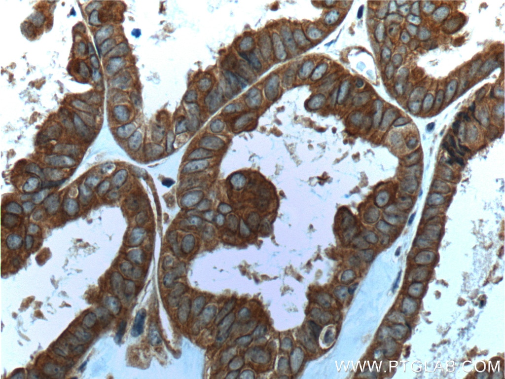 Immunohistochemistry (IHC) staining of human ovary tumor tissue using Follistatin Monoclonal antibody (60060-1-Ig)