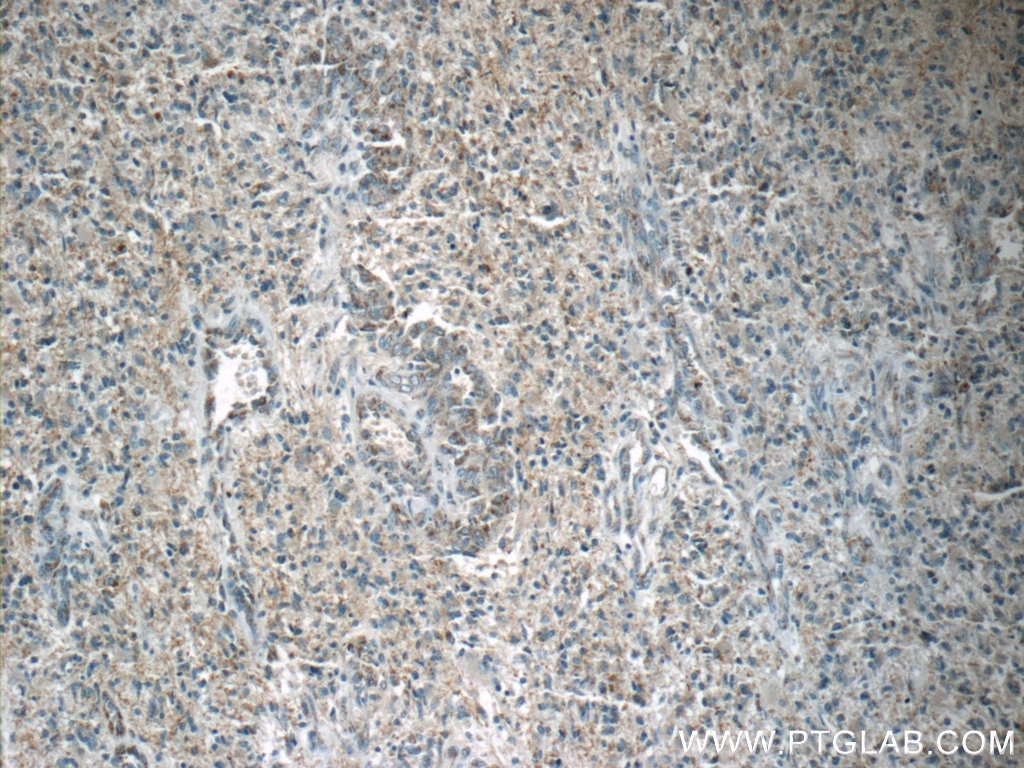 IHC staining of human gliomas using 20182-1-AP