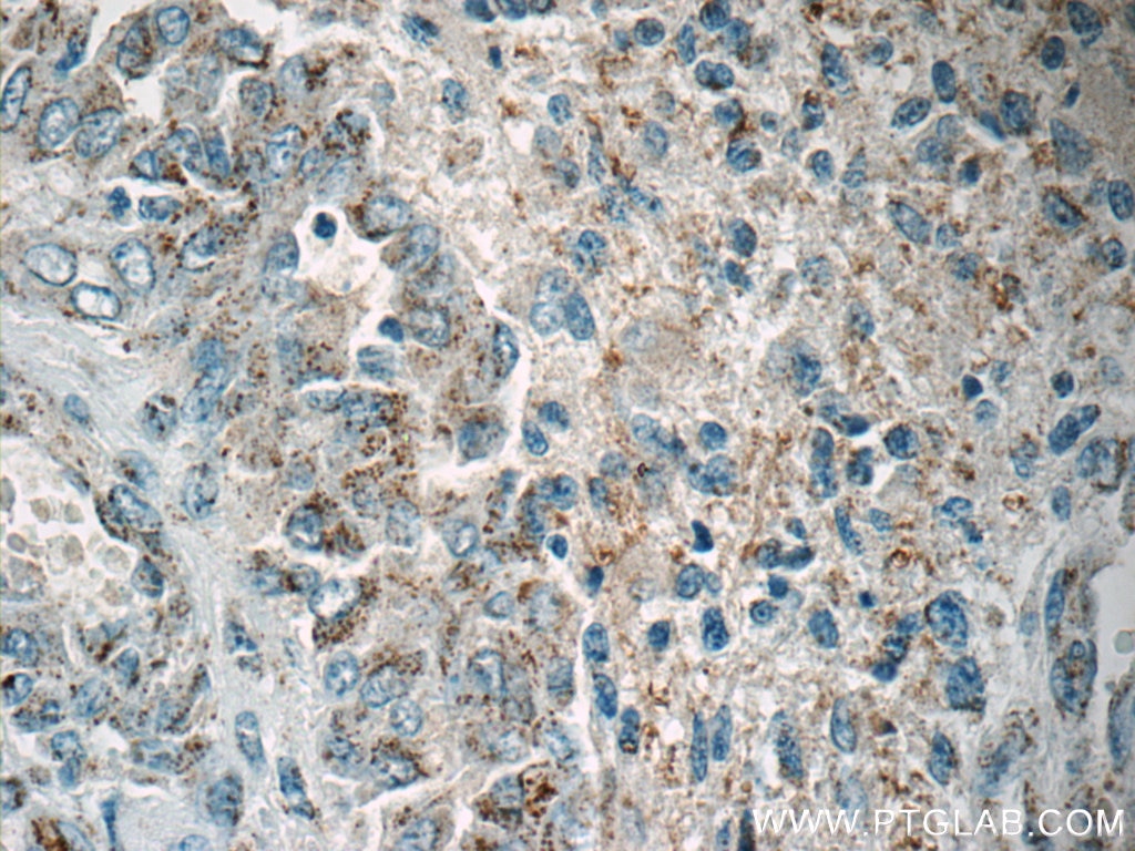Immunohistochemistry (IHC) staining of human gliomas tissue using FSTL1 Polyclonal antibody (20182-1-AP)