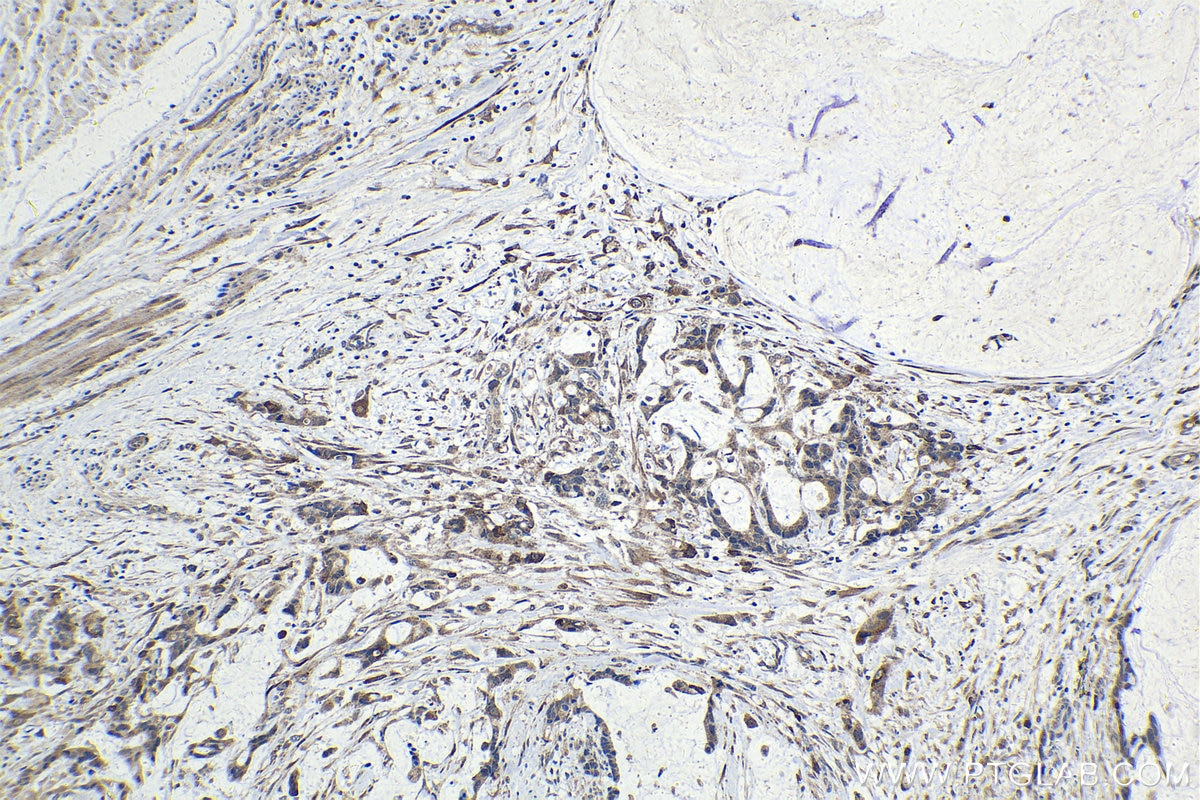 Immunohistochemistry (IHC) staining of human urothelial carcinoma tissue using FSTL3 Polyclonal antibody (28218-1-AP)