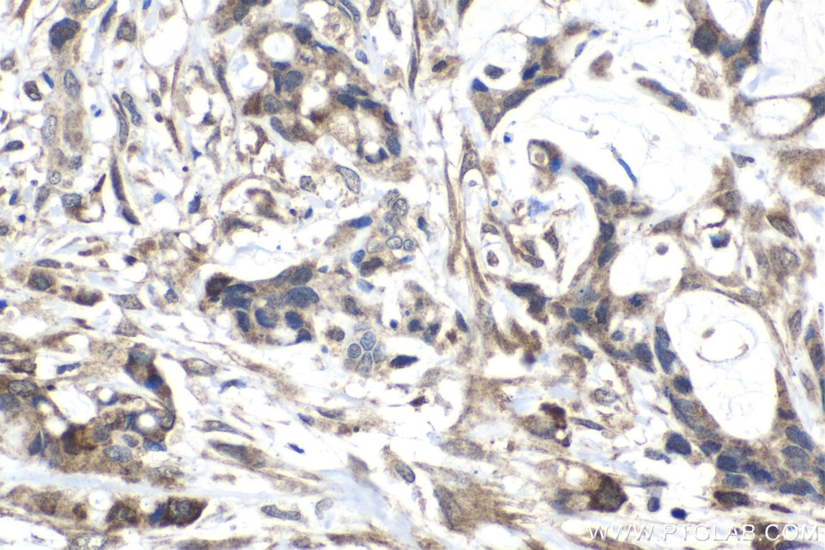 Immunohistochemistry (IHC) staining of human urothelial carcinoma tissue using FSTL3 Polyclonal antibody (28218-1-AP)