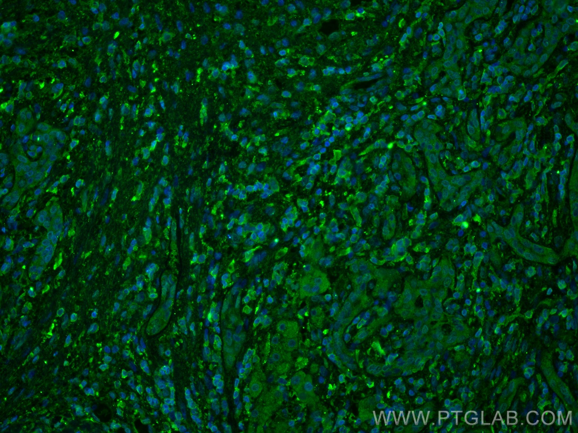 Immunofluorescence (IF) / fluorescent staining of human liver cancer tissue using FTCD Monoclonal antibody (66979-1-Ig)