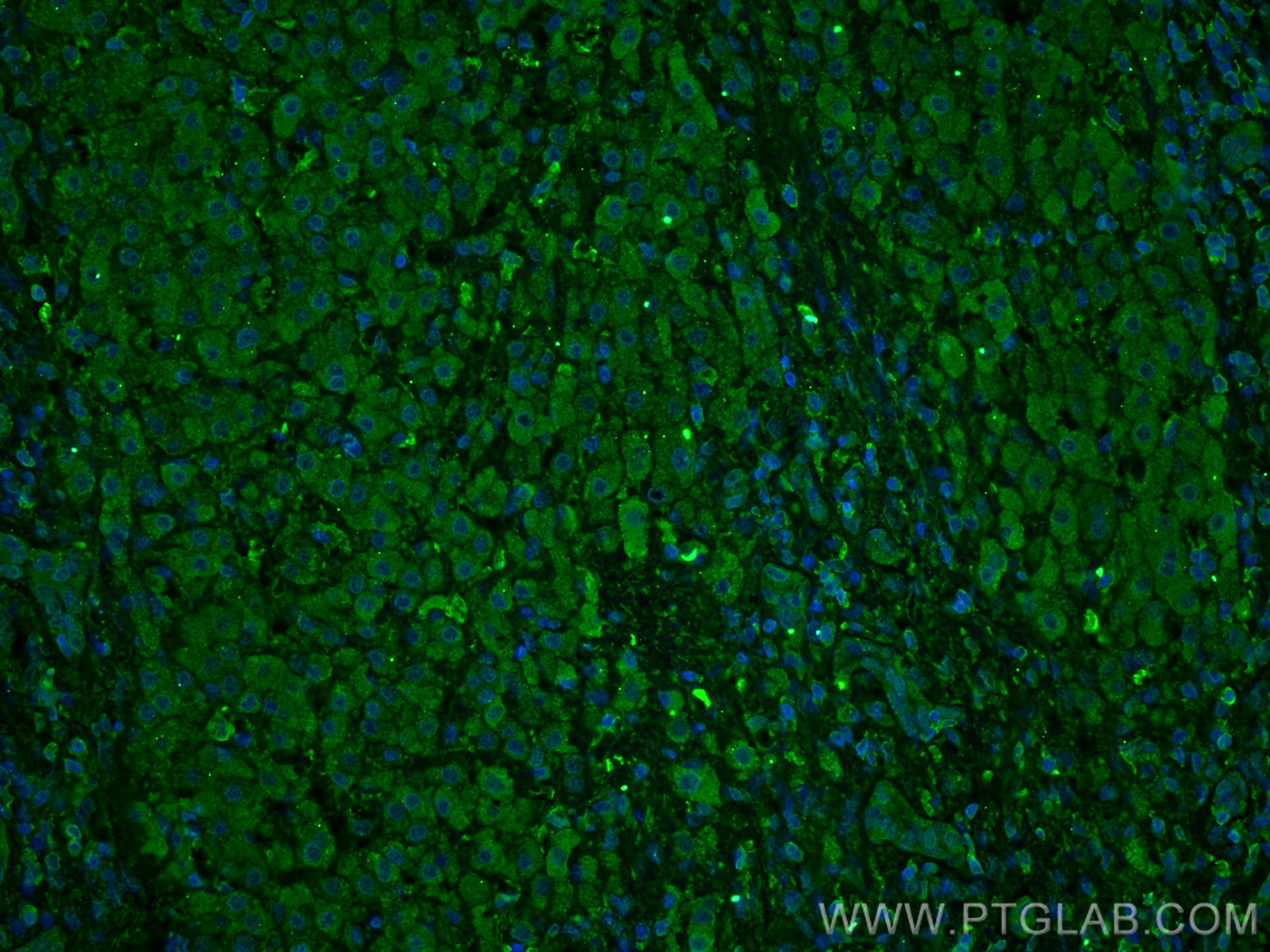 Immunofluorescence (IF) / fluorescent staining of human liver cancer tissue using FTCD Monoclonal antibody (66979-1-Ig)