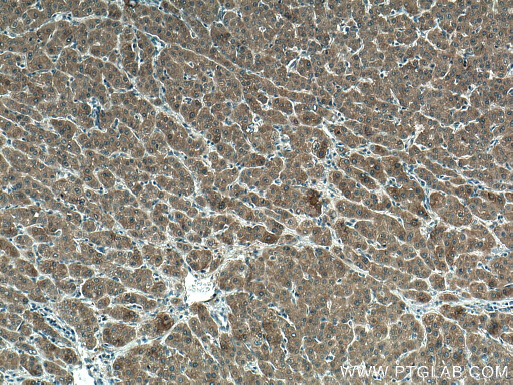 Immunohistochemistry (IHC) staining of human liver cancer tissue using FTCD Monoclonal antibody (66979-1-Ig)