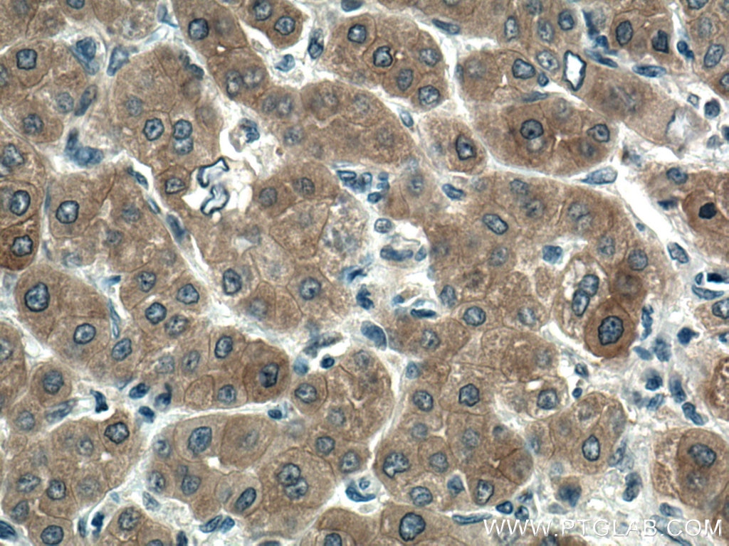 Immunohistochemistry (IHC) staining of human liver cancer tissue using FTCD Monoclonal antibody (66979-1-Ig)