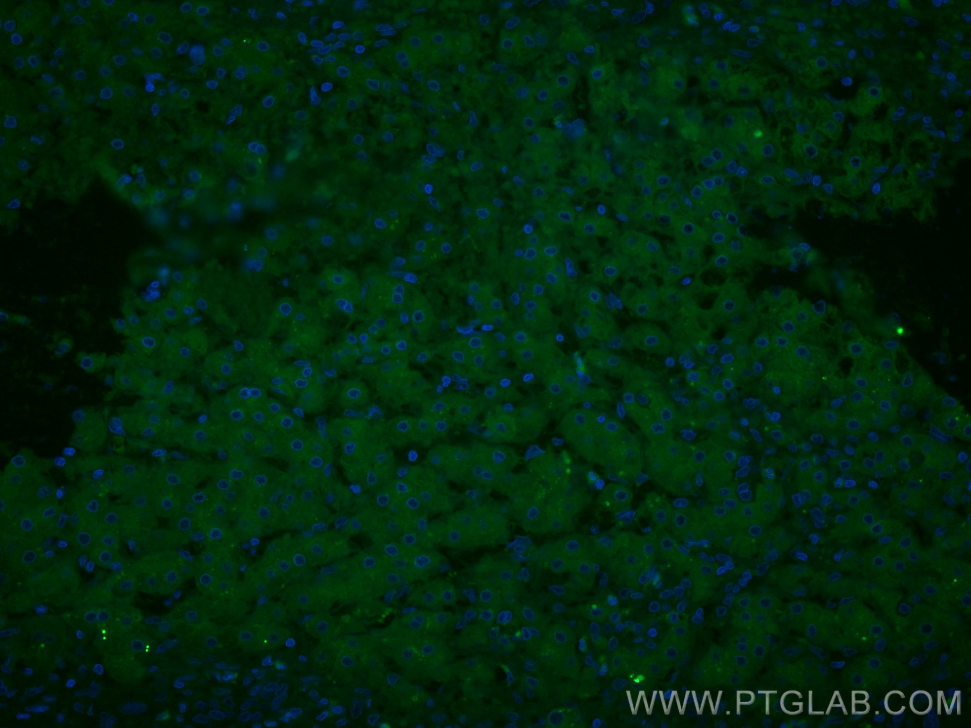 Immunofluorescence (IF) / fluorescent staining of human liver cancer tissue using CoraLite® Plus 488-conjugated FTCD Monoclonal anti (CL488-66979)