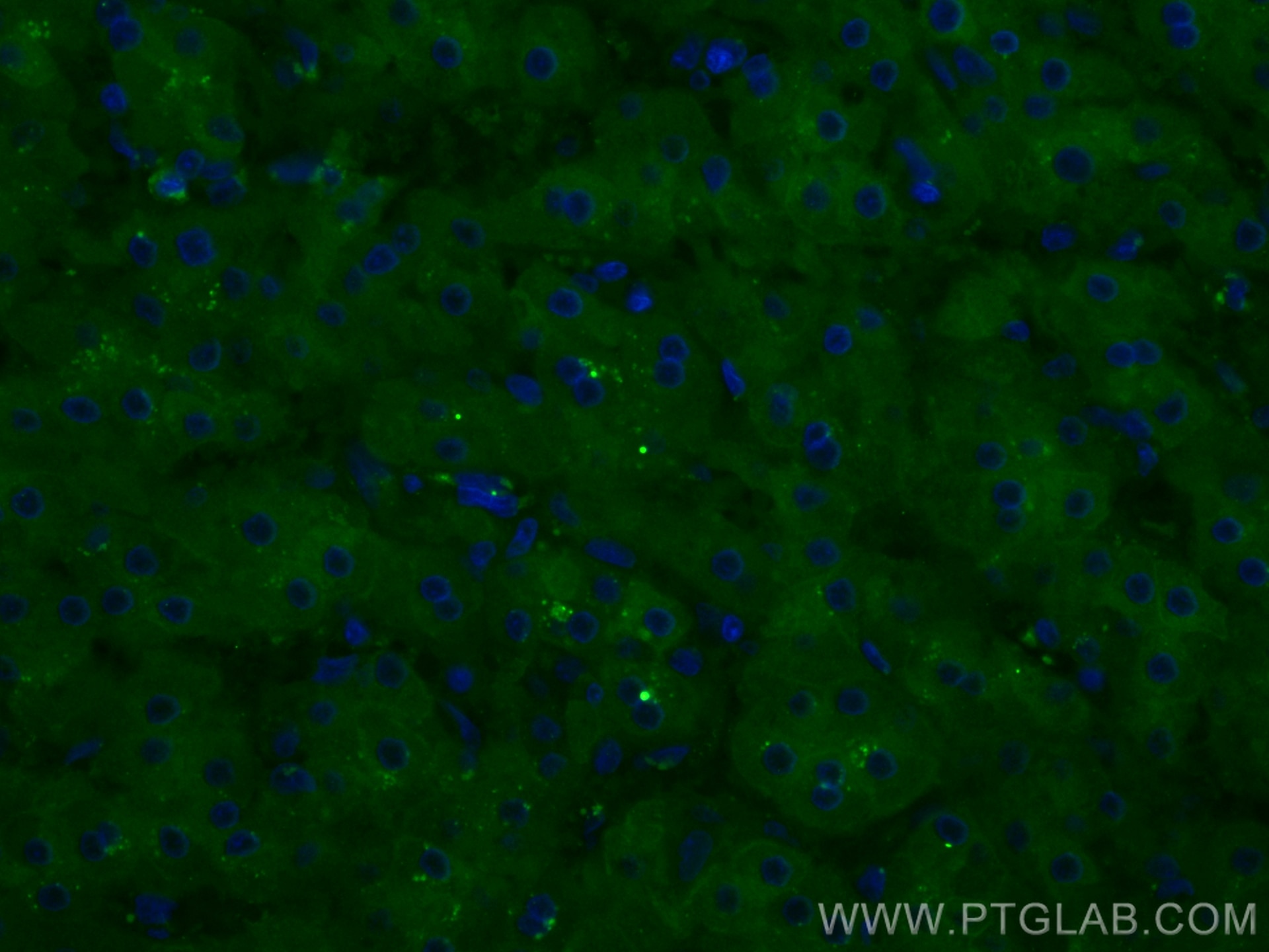 Immunofluorescence (IF) / fluorescent staining of human liver cancer tissue using CoraLite® Plus 488-conjugated FTCD Monoclonal anti (CL488-66979)