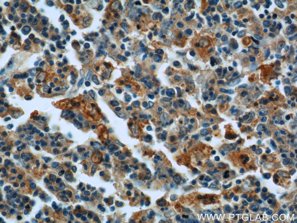 Immunohistochemistry (IHC) staining of human spleen tissue using Ferritin light chain Polyclonal antibody (10727-1-AP)