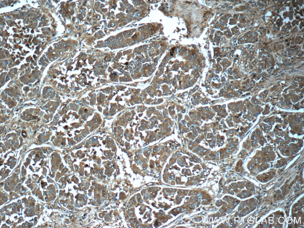 Immunohistochemistry (IHC) staining of human liver cancer tissue using Ferritin light chain Polyclonal antibody (10727-1-AP)