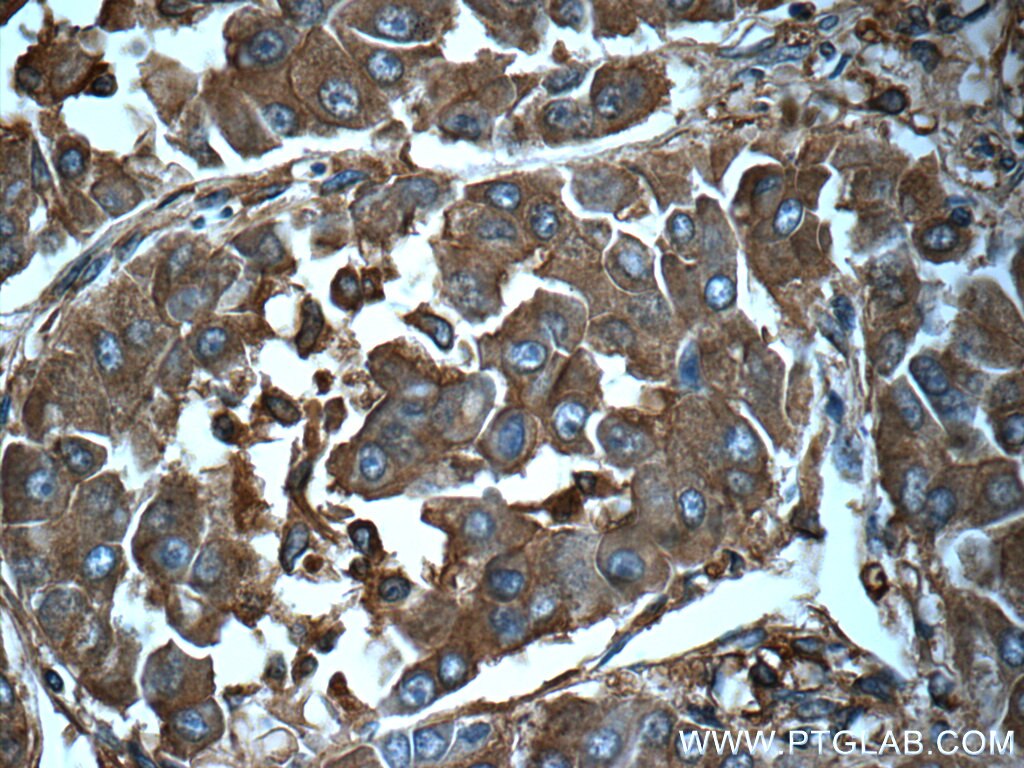 Immunohistochemistry (IHC) staining of human liver cancer tissue using Ferritin light chain Polyclonal antibody (10727-1-AP)
