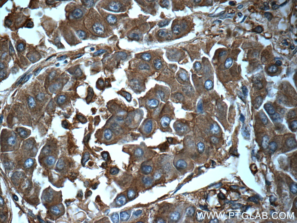 IHC staining of human liver cancer using 10727-1-AP