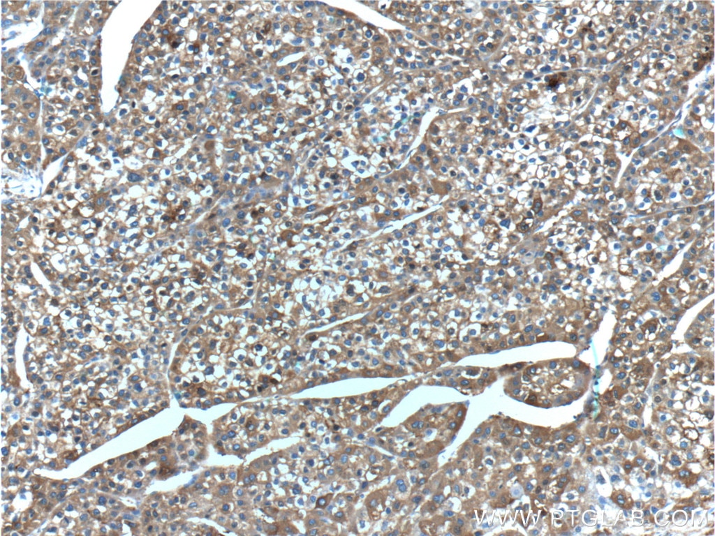 Immunohistochemistry (IHC) staining of human liver cancer tissue using Ferritin light chain Polyclonal antibody (10727-1-AP)