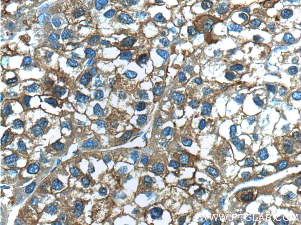 Immunohistochemistry (IHC) staining of human liver cancer tissue using Ferritin light chain Polyclonal antibody (10727-1-AP)