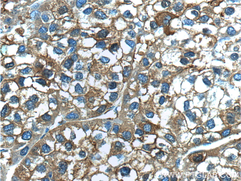 IHC staining of human liver cancer using 10727-1-AP