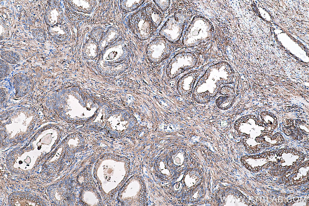 Immunohistochemistry (IHC) staining of human prostate cancer tissue using Ferritin light chain Monoclonal antibody (68068-1-Ig)