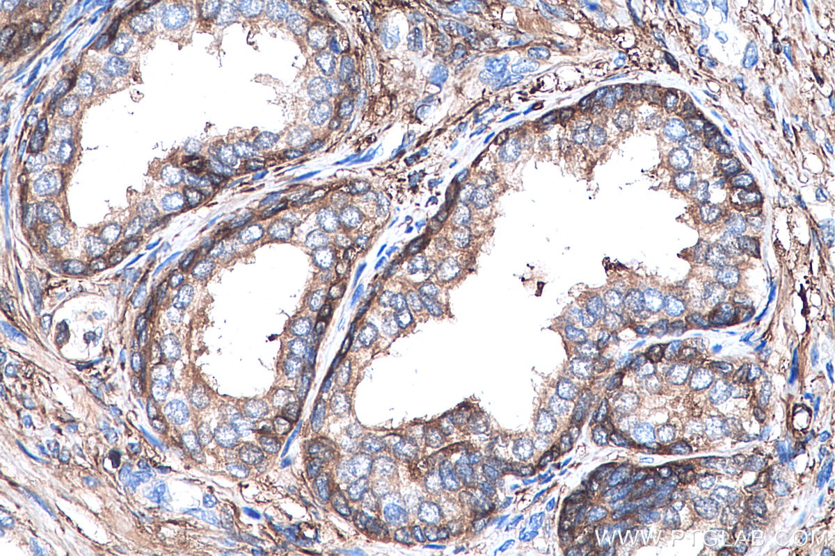 Immunohistochemistry (IHC) staining of human prostate cancer tissue using Ferritin light chain Monoclonal antibody (68068-1-Ig)