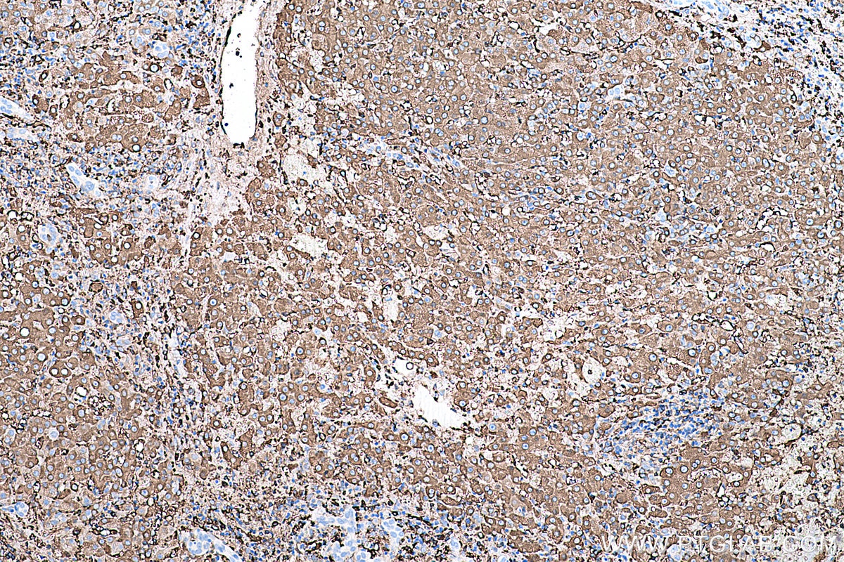 Immunohistochemistry (IHC) staining of human liver cancer tissue using Ferritin light chain Monoclonal antibody (68068-1-Ig)