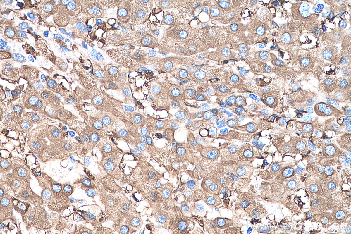 Immunohistochemistry (IHC) staining of human liver cancer tissue using Ferritin light chain Monoclonal antibody (68068-1-Ig)