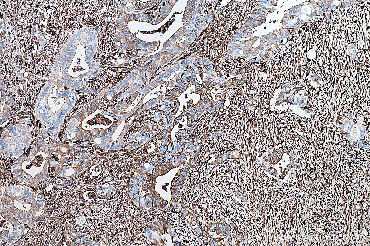 Immunohistochemistry (IHC) staining of human colon cancer tissue using Ferritin light chain Monoclonal antibody (68068-1-Ig)