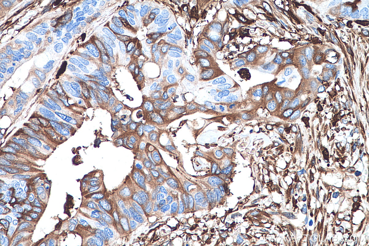 Immunohistochemistry (IHC) staining of human colon cancer tissue using Ferritin light chain Monoclonal antibody (68068-1-Ig)