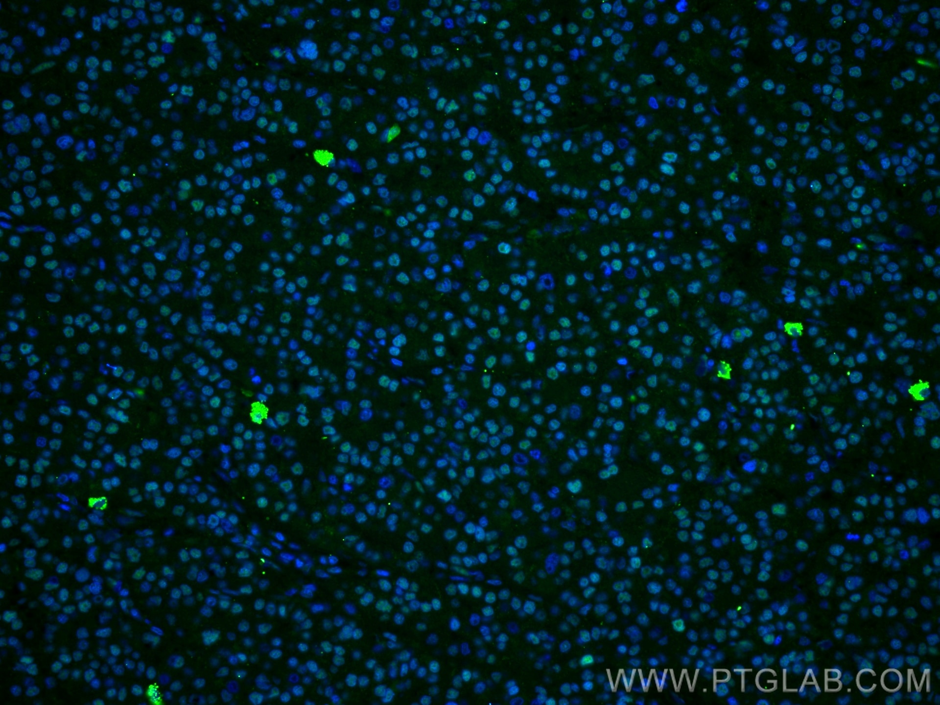 Immunofluorescence (IF) / fluorescent staining of human liver cancer tissue using FTO Polyclonal antibody (27226-1-AP)