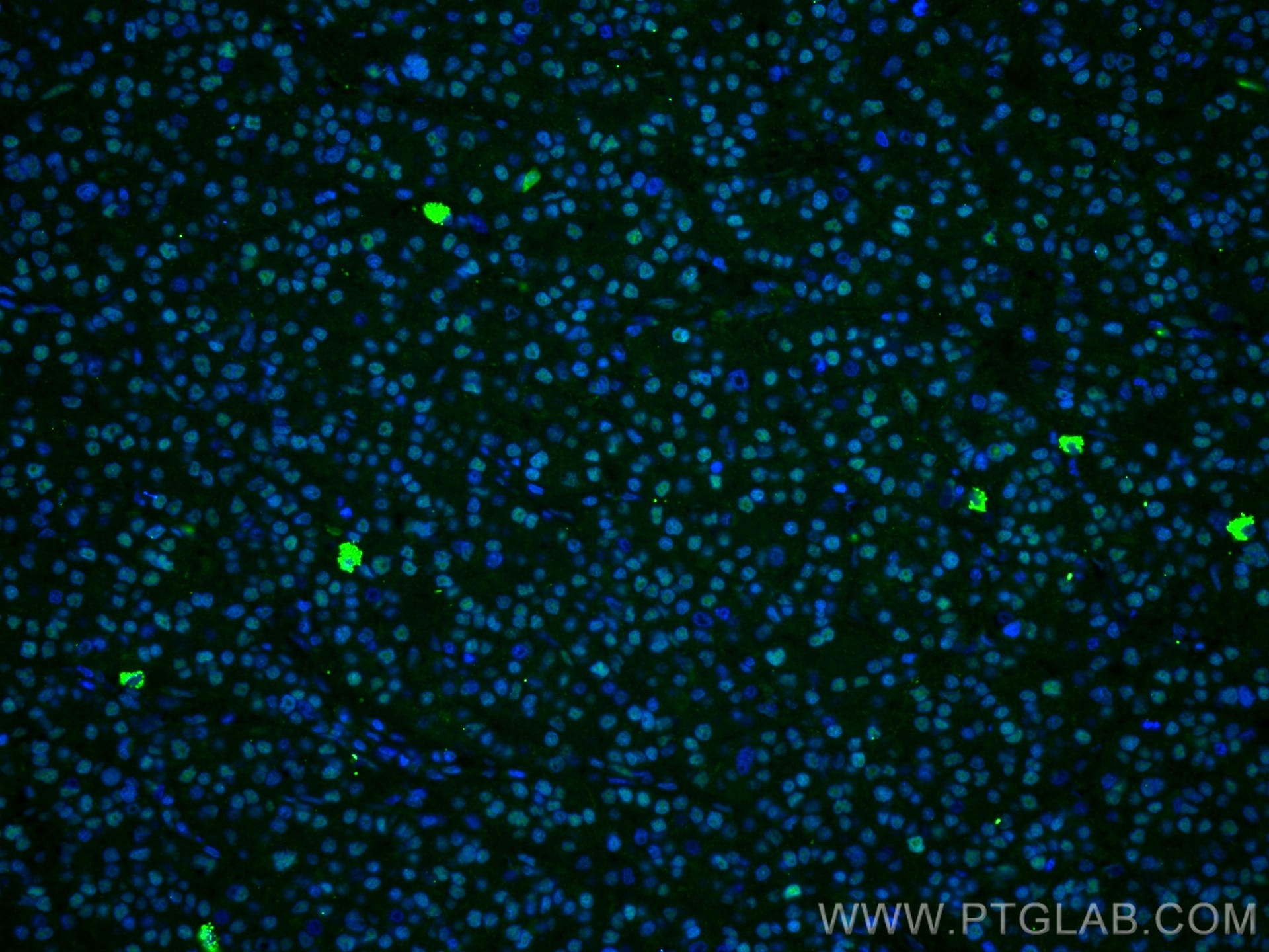 IF Staining of human liver cancer using 27226-1-AP