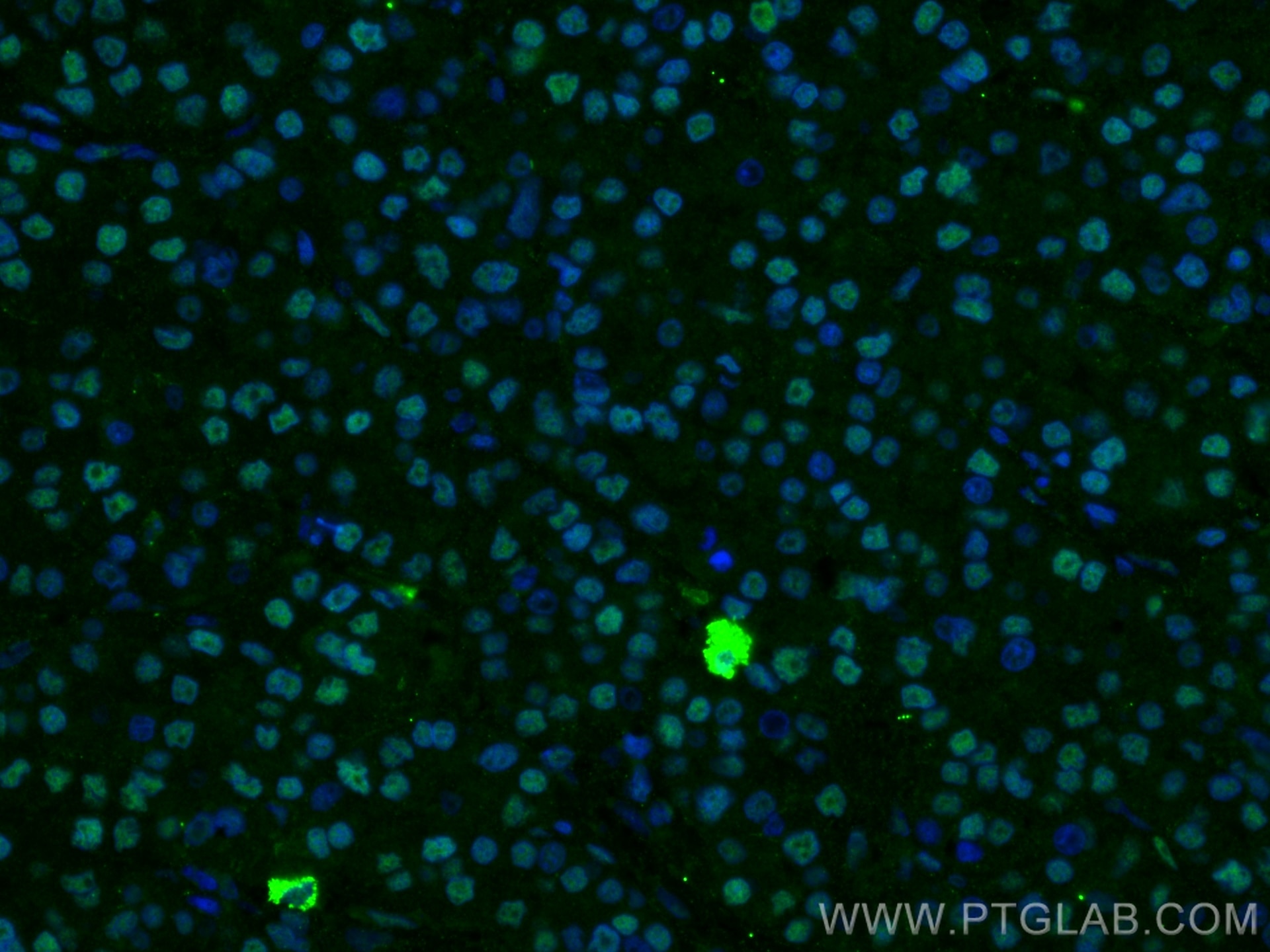 Immunofluorescence (IF) / fluorescent staining of human liver cancer tissue using FTO Polyclonal antibody (27226-1-AP)