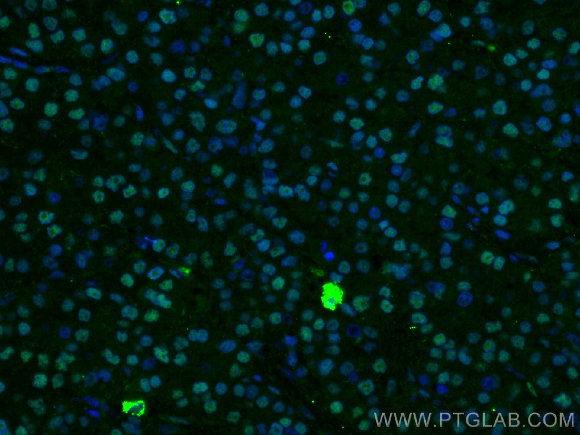 Immunofluorescence (IF) / fluorescent staining of human liver cancer tissue using FTO Polyclonal antibody (27226-1-AP)